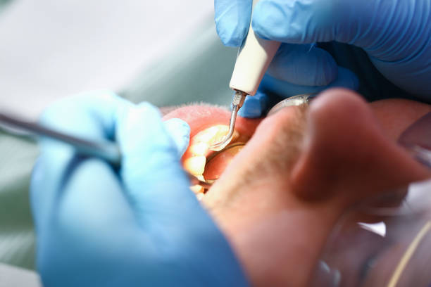 Best Chipped Tooth Repair Near Me  in Battlement Mesa, CO