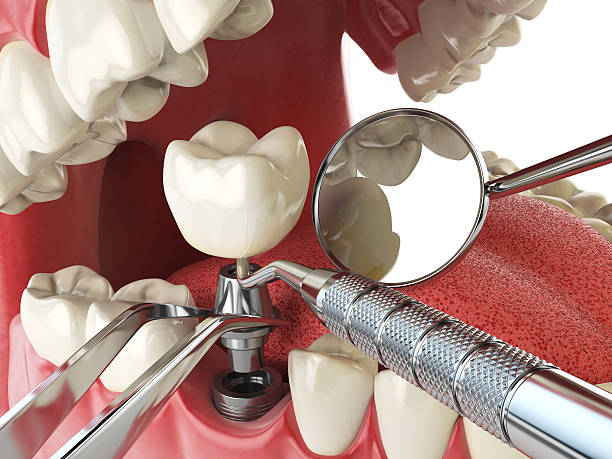Best Cracked Tooth Emergency Dentist  in Battlement Mesa, CO
